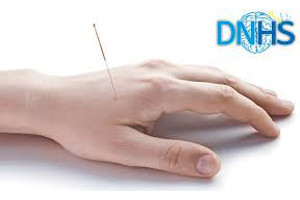 Curos teórico – práctico de la técnica DNHS (Dry Needling for Hypertonia and Spasticity) Nivel I y II. (36 horas)